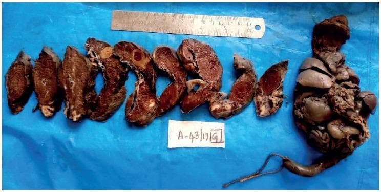 Gross clinical photograph of pathology specimens from a 32-week stillbirth, including cut sections of the placenta and an en bloc eviscerated fetus. The placental sections demonstrate diffuse parenchymal changes, including brownish-red thrombi and focal areas of pale, firm tissue indicative of chronic infarction, common in maternal eclampsia. The en bloc fetal specimen reveals multiple congenital anomalies: marked cardiomegaly, splenomegaly, a hypoplastic liver, and the absence of the left lung. The fetal tissue exhibits post-mortem discoloration and altered morphology consistent with intrauterine death. A ruler is included for scale against a blue background, along with a specimen identification tag. This image serves as a teaching tool for distinguishing between fetal death caused by hypertension-related placental pathology versus primary congenital malformations.