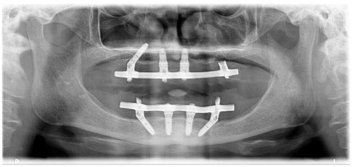This orthopantomogram (panoramic X-ray) displays a preoperative view of a patient with full-arch dental rehabilitation. The maxilla (upper arch) contains three visible root-form metallic implants; the two anterior implants are vertically oriented, while one posterior implant is distally tilted. A notable absence of a posterior tilted implant is seen in the third sextant. In the mandible (lower arch), four root-form implants are present following the All-on-4 concept: two vertical anterior implants and two mesially tilted posterior implants. Both arches feature radiopaque horizontal bars connected to the implants, stabilizing the prosthetic frameworks. Significant craniofacial landmarks are visualized, including the bilateral temporomandibular joints (TMJs) with defined mandibular condyles, the radiolucent nasal cavity divided by the septum, and bilateral maxillary sinuses. The alveolar bone demonstrates radiographic density and close adaptation to the implant interfaces without significant peri-implant radiolucency. This diagnostic image is used in dental implantology to evaluate bone quantity and prosthetic alignment.