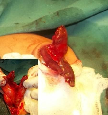 This clinical photograph and surgical inset document a rare case of a high umbilical cord (HUC) hernia associated with congenital loss of the midgut. The main image shows a segment of bowel protruding through an umbilical defect, characterized by its dark reddish-brown and vivid red coloration, suggesting a collapsed and potentially ischemic or highly vascularized state. The tissue exhibits a glistening serosal surface with irregular folds. The inset image provides a closer view of the surgical manipulation, where the remnant gut is being held open to reveal its internal morphology. It demonstrates the extremely short length of the available bowel, specifically showing a few inches of proximal jejunum and distal sigmoid colon, with an absence of the intervening midgut structures. The exposed tissues in the inset are bright red and show disorganized, lobed projections. This visual is significant for pediatric surgery and embryology, illustrating a severe intestinal atresia or congenital absence of the midgut within an umbilical cord hernia.