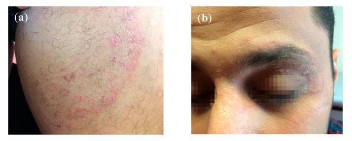 This composite of clinical photographs illustrates a case of multi-focal dermatophytosis caused by T. mentagrophytes Type VIII in a 28-year-old male. Panel (a) displays tinea cruris, characterized by a large, annular (ring-shaped) erythematous lesion on the groin or thigh. The lesion features a prominent, raised, red, and scaly advancing border with evidence of central clearing and smaller adjacent satellite papules. Panel (b) depicts tinea faciei with periocular involvement. An erythematous, scaly, ring-like lesion is visible affecting the left upper and lower eyelids, as well as the supraorbital (eyebrow) region. The plaques demonstrate classic fungal morphology with peripheral inflammation and a dry, flaky texture. These images illustrate the clinical presentation of chronic, recalcitrant dermatophytosis, which may be resistant to standard terbinafine treatment. The case highlights the importance of recognizing fungal skin infections in different anatomical regions (cruris vs. faciei) within the same patient.