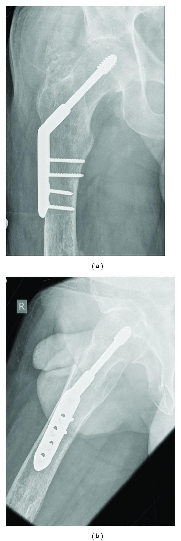 Two postoperative plain film radiographs (Anteroposterior and Lateral views) demonstrating surgical fixation of a right intertrochanteric hip fracture. The imaging displays a Dynamic Hip Screw (DHS) system consisting of a large-diameter lag screw inserted through an angled barrel into the femoral head, traversing the fracture site to provide compression. A lateral side plate is affixed to the proximal femoral shaft with four cortical screws. The AP view (a) shows the anatomical alignment of the proximal femur with the lag screw positioned centrally within the femoral head. The lateral view (b), marked with an 'R' indicator, confirms the hardware position and reveals the soft tissue contours of the thigh. Key landmarks visible include the acetabulum, greater trochanter, and the proximal femoral shaft. This visual material is used in orthopedic education to illustrate the internal fixation of extracapsular hip fractures and the components of the DHS construct.