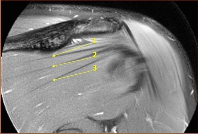 This diagnostic image is a T2-weighted magnetic resonance image (MRI) using a spectral adiabatic inversion recovery (SPAIR) sequence in a coronal section. It demonstrates the normal anatomy and variations of the infraspinatus muscle of the rotator cuff. The visual focus is on the numerous dark, linear, hypointense bands labeled with numerical arrows (1, 2, 3), which represent intramuscular tendons. These tendons are composed of dense connective tissue and are seen running longitudinally, generally parallel to the muscle fibers. The superior border of the image shows the scapular spine, which acts as a landmark for the 'central measuring point' under the deltoid tubercle. This imaging modality and view are used in musculoskeletal radiology to assess the internal architecture of the rotator cuff muscles, which can be relevant for evaluating muscular health, volume, and potential tendinopathy or fiber disruption in the shoulder.