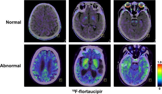 This Comparison Chart features a series of transaxial 18F-flortaucipir PET/CT fusion images of the brain, demonstrating tau protein deposition patterns. The image is organized into two rows: 'Normal' (top) representing a healthy elderly individual and 'Abnormal' (bottom) representing a patient with Alzheimer’s Disease (AD). The color scale on the right indicates radiotracer intensity, with green and yellow representing high retention. In the 'Normal' row, the brain shows minimal cortical radiotracer uptake, with some physiological off-target binding in deep brain structures and the retina. In contrast, the 'Abnormal' row displays marked, bilateral radiotracer retention across several cortical regions, specifically the inferior lateral temporal lobes, temporoparietal junctions, and the posterior cingulate cortex. These findings correlate with advanced Braak staging of tau pathology in AD. The image serves as a diagnostic reference for identifying neurodegenerative tauopathies and illustrates the clinical utility of tau-specific PET imaging in geriatric neurology.