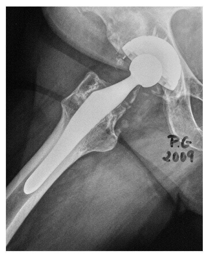 This diagnostic X-ray shows a right total hip arthroplasty (THA) in a four-year follow-up status. The visual content demonstrates an original cementless ABG I prosthesis consisting of a metallic femoral stem and an acetabular cup. The femoral stem is anatomically positioned within the medullary canal of the proximal femur, showing stable osseointegration. A metallic femoral head is articulated with the acetabular cup. Notably, there is evidence of post-surgical changes in the periprosthetic acetabular region where radiodense material indicates the placement of bone graft to address previous osteolysis. The proximal femur shows some signs of bone remodeling, including mild radiolucency in the superior metaphyseal region (Gruen zones 1 and 7), which is suggestive of stress shielding—a common phenomenon where the rigid metal implant alters normal load distribution. The alignment of the implant components appears stable with no signs of hardware loosening, migration, or fracture.
