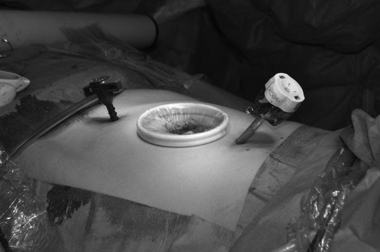This clinical photograph displays a surgical field during a laparoscopic procedure, specifically focusing on an abdominal port site. A centrally positioned Alexis wound retractor is seen inserted into an extended port site incision. The retractor consists of a rigid, white circular outer ring resting on the skin surface, connected to a translucent cylindrical sheath that lines the incision and keeps the wound edges retracted. Flanking the central retractor are two laparoscopic trocars: one black trocar on the left and one larger trocar with a white, labeled head (Ethicon Endopath Xcel) on the right, both angled toward the surgical target. The image demonstrates a technique for specimen extraction or stoma site preparation where atraumatic retraction is required. This visual is relevant for general and colorectal surgery educational modules, illustrating wound protection and the maintenance of pneumoperitoneum during complex abdominal surgery.