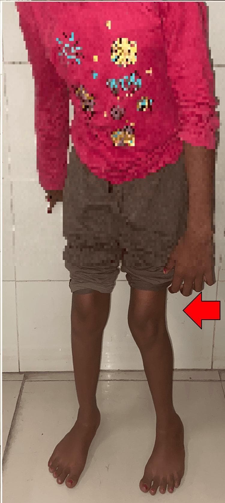 This clinical photograph displays a pediatric patient exhibiting classic postural signs associated with spastic diplegic cerebral palsy. The image focuses on the lower extremities, showing significant internal rotation and adduction at the hips. The knees are positioned close together, and there is evident in-toeing (metatarsus adductus) of the feet, which are oriented toward the body's midline. This characteristic alignment, often described as a 'scissoring' posture, is indicative of underlying spasticity and muscle contractures, specifically in the hip adductors and internal rotators. The red arrow highlights the medial deviation of the left leg. This visual is used in medical education to illustrate the pre-operative clinical presentation of spastic gait abnormalities and pelvic obliquity in neuromusculoskeletal disorders, serving as a baseline for surgical interventions such as adductor tenotomy and gracilis release.