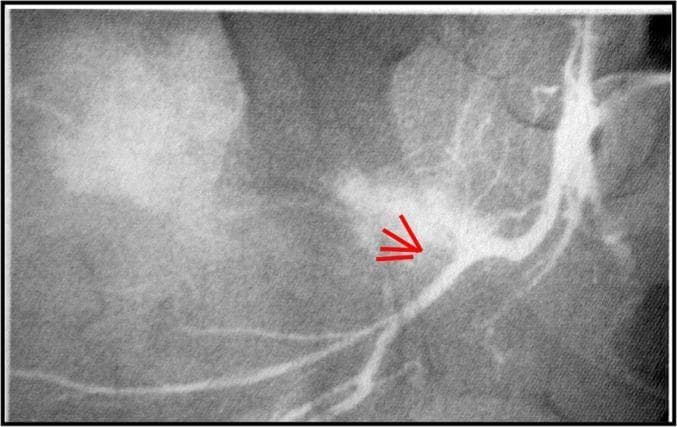 This diagnostic image is an angiogram of the pelvic region, focusing on the arterial supply to the gluteal area. The primary feature is a contrast-filled superior gluteal artery. Red arrows highlight a specific site of vascular damage characterized by contrast extravasation, indicating a vessel wall rupture or active hemorrhage. The normal smooth contour of the arterial trunk is interrupted by a focal area of irregular hyperdensity (contrast leakage) into the surrounding soft tissues. Anatomical landmarks include the trunk of the internal iliac artery and its posterior division branches. The surrounding musculature and pelvic bony structures are visible in the background with varying radiographic densities. This image demonstrates a traumatic vascular injury, likely secondary to a pelvic fracture, and serves as an educational example of how angiography is used to identify site-specific arterial bleeding in orthopedic trauma cases.