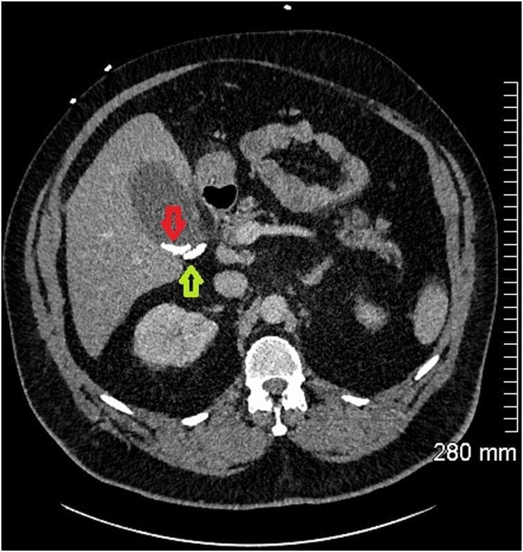 This diagnostic image is an axial CT scan of the abdomen at the level of the biliary system. The visual focus is on the gallbladder and cystic duct, which exhibit multiple hyperdense, calcified gallstones (cholelithiasis). Specifically, a red arrow indicates a cluster of bright white, high-attenuation stones located within the gallbladder fundus/body. Adjacent to this, a green arrow points to another calcified stone lodged within the cystic duct. The surrounding anatomy includes the liver, appearing as a homogenous gray parenchymal structure to the left of the gallbladder, and the right kidney located posteriorly. The vertebral body is visible at the bottom center of the frame as a high-density cortical structure. The image demonstrates key diagnostic features of calculous biliary disease and potential obstructive cholecystitis, characterized by the localization of radio-opaque calculi in the biliary drainage tract.