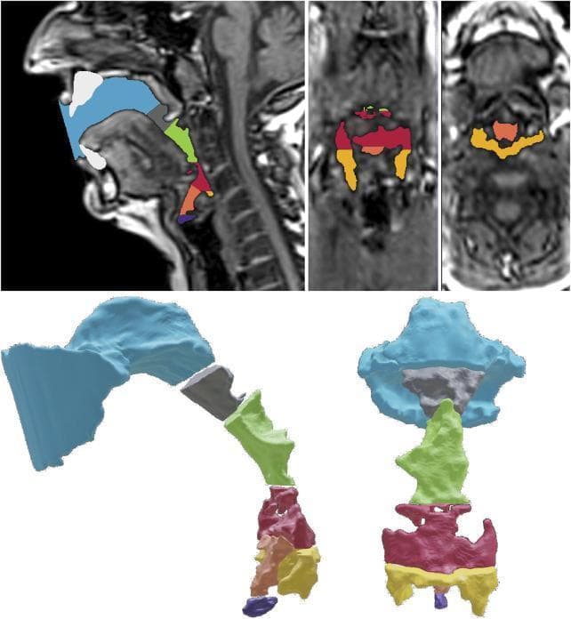 This diagnostic and anatomical diagram composite displays the volumetric segmentation of the human vocal tract based on MRI data. The top row features high-resolution MRI scans in mid-sagittal, coronal, and transversal planes, where specific anatomical sub-volumes are color-coded over the airway. The bottom row presents a corresponding 3D 'exploded view' of these segmented cavities in sagittal and coronal perspectives. The color-coding scheme identifies seven distinct regions: blue for the oropharynx front (OPf), gray for the oropharynx rear (OPR), green for the upper hypopharynx (HPu), red for the lower hypopharynx (HPl), orange for the epilarynx tube (ET), yellow for the sinus piriformis (SP), and purple for the ventricular volume (VV). This visualization is used in speech science and otolaryngology to analyze the complex geometry and resonance characteristics of the vocal tract during phonation. The segmentation highlights the relationship between the supra-glottal structures, emphasizing how different cavities contribute to the overall shape of the pharynx and laryngeal vestibule.