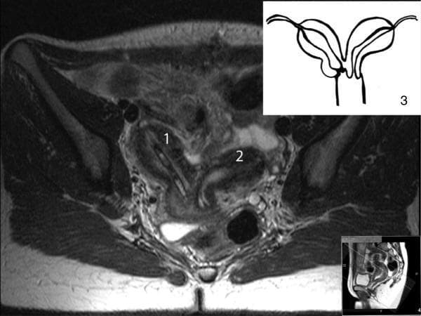 This composite educational image features an axial T2-weighted magnetic resonance image (MRI) of the female pelvis and an accompanying anatomical illustration (3) demonstrating a Müllerian duct anomaly, specifically a bicornuate or didelphys uterus. The MRI highlights two distinct uterine horns: the right horn (1) and the left horn (2). A linear hypointense structure is visible within the right uterine cavity, representing a postoperative drainage tube. The T2-weighted sequence provides high contrast, showing the hyperintense (fluid-filled) endometrial cavities against the intermediate-signal myometrium. The anatomical diagram (3) provides a schematic representation of the dual-chambered uterine configuration, illustrating the separation of the horns and their relationship to the cervical region. This visual is designed for medical students and clinicians to study congenital uterine malformations and postoperative radiological assessment. Clinical relevance includes the diagnosis of obstructive reproductive tract anomalies and associated renal conditions like kidney aplasia.