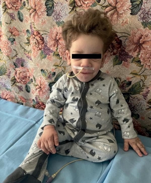 This clinical photograph shows an 18-month-old male patient in a seated position, demonstrating the practical application of a nasogastric (NG) tube for enteral nutrition or gastric decompression in a pediatric setting. The thin, translucent, flexible catheter is inserted through the patient's right naris and is secured to the philtrum and cheek with medical adhesive tape to prevent displacement. The tubing extends downward across the chest. The child is shown with curly hair and typical pediatric proportions for his age, seated on a blue medical examination surface. This image serves as a clinical example of long-term or home-based enteral support in pediatrics, illustrating proper tube placement and fixation. The patient is wearing patterned pajamas, and the background features a floral pattern, suggesting a home care or community health environment rather than an acute hospital setting.