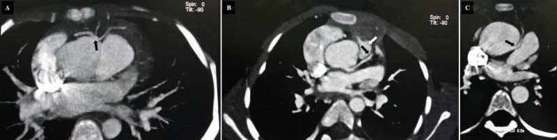 Diagnostic Image: Cardiac CT Angiography (CCTA) axial slices demonstrating various coronary artery anomalies. Panel A shows an anomalous origin of the left anterior descending (LAD) coronary artery from the right coronary artery (RCA), indicated by a black arrow. Panel B illustrates the LAD passing in close proximity to the pulmonic valve, with arrows highlighting the vessel's course. Panel C depicts the RCA originating from the left coronary cusp (LCC) with a high-risk interarterial course between the aorta and the pulmonary artery, marked by a black arrow. These images showcase congenital coronary anomalies often associated with structural heart diseases like Tetralogy of Fallot. The visual focus is on the anomalous takeoff points (ectopic origins) and the subsequent anatomical pathways (prepulmonary vs. interarterial) relative to the great vessels and heart valves. This content serves as an educational resource for cardiology and radiology specialties to identify potentially malignant coronary vessel trajectories using non-invasive imaging.