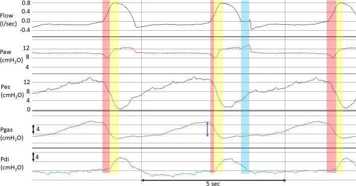 Multi-panel physiological waveform tracing from a patient with Acute Respiratory Distress Syndrome (ARDS) on Proportional Assist Ventilation (PAV+). The diagram displays three respiratory cycles, including an end-inspiratory occluded breath between two unoccluded breaths. The plotted variables include Flow (l/sec), Airway Pressure (Paw), Esophageal Pressure (Pes), Gastric Pressure (Pgas), and Transdiaphragmatic Pressure (Pdi). Color-coded shading highlights phases of muscle activity: red areas indicate initial inspiratory flow generated by expiratory muscle relaxation; yellow areas represent subsequent diaphragmatic contraction; and the blue area marks the end-inspiratory pause (zero flow) during occlusion. Significant expiratory muscle activity is evidenced by a rise in Pgas during expiration (indicated by a blue double-edged arrow). The tracing illustrates how expiratory muscle relaxation contributes to early inspiratory volume and demonstrates the impact of active breathing on transpulmonary driving pressure (ΔPlung) versus respiratory system driving pressure (ΔPrs) calculations. Baseline Pdi returns at the end of the occlusion, indicating a passive state for plateau pressure (Pplat) measurement.