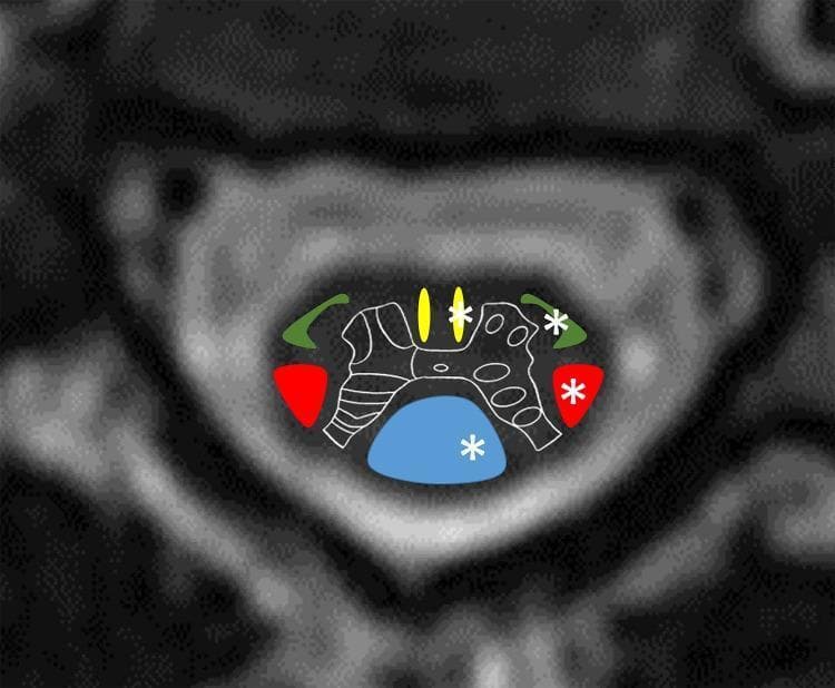 This composite diagnostic image features an axial cross-sectional graphic of the cervical spinal cord anatomy superimposed on a radiological background. The illustration uses color-coded regions to delineate primary white matter tracts: the dorsal column-medial lemniscus system is shown in blue (posteriorly), the lateral corticospinal tracts in red (laterally), the anterior corticospinal tracts in yellow (medial-anteriorly), and the anterolateral system (spinothalamic tract) in green (anterolaterally). A white outline represents the central grey matter of the spinal cord. White asterisks are strategically placed on the left hemicord tracts (blue, red, yellow, and green regions) to indicate the site of anatomical damage associated with a left-sided spinal cord lesion. This visual aid is designed to explain the pathophysiology of Brown-Séquard syndrome, illustrating how a hemicord injury affects specific ascending and descending pathways, leading to ipsilateral motor/proprioceptive loss and contralateral pain/temperature loss.