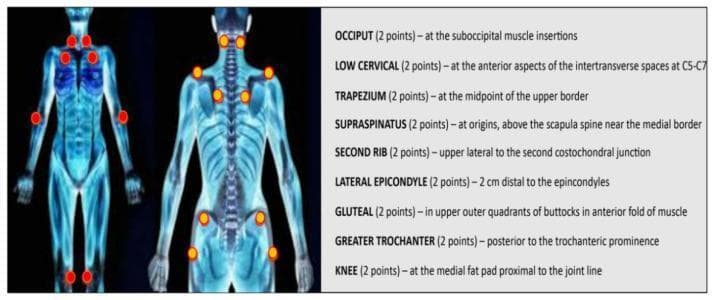 Anatomical diagram and infographic illustrating the 18 specific tender points used in the diagnosis of fibromyalgia, as defined by the 1990 American College of Rheumatology (ACR) criteria. The image features two stylized human silhouettes—one anterior and one posterior—with bilateral orange/red dots marking the location of the tender points. The points are distributed across the body including: suboccipital muscle insertions (occiput), low cervical intertransverse spaces (C5-C7), midpoint of the upper trapezius border, supraspinatus origins above the scapular spine, second costochondral junctions, 2 cm distal to the lateral epicondyles, upper outer quadrants of the gluteal muscles, posterior to the greater trochanteric prominence, and the medial fat pad of the knee proximal to the joint line. A text panel on the right provides a structured list of these nine bilateral pairs, totaling 18 points, with brief anatomical descriptions for each site. This educational material is designed for clinical training in rheumatology and physical examination techniques.