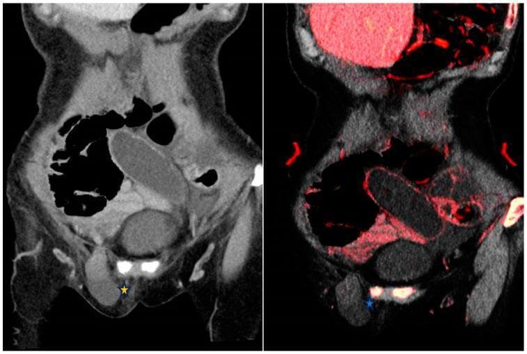 This diagnostic image displays side-by-side coronal CT views of the abdomen and pelvis, comparing a conventional 120 kVp contrast-enhanced image (left) with a dual-energy CT (DECT) iodine overlay map (IOM, right). The clinical focus is a closed-loop small bowel obstruction secondary to a right inguinal hernia, marked with an asterisk (*). On the conventional image, the incarcerated bowel loop within the inguinal region appears hypoattenuating but mural enhancement is difficult to definitively assess. The corresponding IOM image enhances clinical conspicuity by color-coding iodine distribution in red; the lack of red color in the herniated bowel wall confirms absent mural enhancement, a critical finding highly suggestive of bowel ischemia or strangulation. This comparison illustrates the utility of spectral CT in differentiating viable from non-viable bowel segments by objectively visualizing iodine uptake, which is more subtle on standard polychromatic CT. Key structures visible include the dilated proximal bowel loops and the constricted segment entering the inguinal canal.