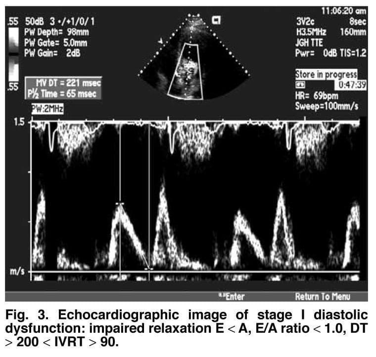 This diagnostic image is a transthoracic pulse-wave (PW) Doppler echocardiogram demonstrating transmitral inflow velocities. The spectral tracing illustrates a classic 'impaired relaxation' filling pattern characteristic of Grade I diastolic dysfunction. Key visible features include a reversal of the normal E/A ratio, where the E-wave (early diastolic filling velocity) is noticeably smaller than the A-wave (late diastolic atrial contraction velocity), resulting in an E/A ratio < 1.0. Quantitative measurements displayed on the screen include a prolonged mitral valve deceleration time (MV DT) of 221 msec and a pressure half-time (P 1/2 Time) of 65 msec. The top portion of the display provides an anatomical reference in the apical four-chamber view, with the Doppler sample gate positioned at the mitral valve leaflets. Clinical parameters such as a heart rate (HR) of 69 bpm and a sweep speed of 100 mm/s are also recorded. This imaging study is essential for cardiologists and sonographers in assessing left ventricular compliance and filling pressures.