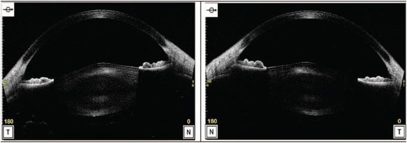 Diagnostic Image: Anterior segment optical coherence tomography (AS-OCT) cross-sections of the right eye (left panel) and left eye (right panel). The images demonstrate bilateral anterior lenticonus, characterized by a distinct conical or globular protrusion of the central anterior lens surface into the anterior chamber. The overlying cornea maintains a relatively normal curvature, and the anterior chamber depth is visible. Within the lens substance, there are hyperreflective areas, particularly in the posterior cortex, consistent with posterior subcapsular cataract. These findings are pathognomonic clinical markers for Alport Syndrome (AS). The AS-OCT provides a high-resolution morphological assessment of the lens capsule and cortex, illustrating the localized thinning and outward bulging of the lens capsule. This diagnostic imaging is essential for ophthalmology education regarding hereditary basement membrane disorders and the surgical planning for lenticonus-related visual impairment.