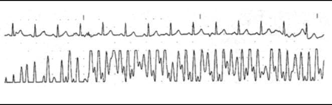 This diagnostic image displays a dual-trace physiological monitoring strip consisting of an electrocardiogram (ECG) and a pulse oximeter plethysmogram (PPG). The top trace is a standard ECG showing a regular sinus rhythm with visible P waves, QRS complexes, and T waves, maintaining a consistent baseline with minor noise. In contrast, the bottom trace depicts a pulse oximeter plethysmogram waveform exhibiting significant signal distortion and interference. The PPG waveform shows irregular morphology, fluctuating amplitudes, and high-frequency artifacts that obscure the typical dicrotic notch and pulsatile flow pattern. This visual evidence demonstrates optical crosstalk or external infrared interference, specifically attributed to surgical navigation systems like the StealthStation. The clinical significance lies in the recognition of artifact-induced waveform corruption, which can lead to erroneous SpO2 readings and false clinical alarms in a perioperative or critical care environment.