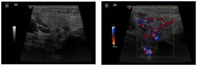 This comparative ultrasound study displays the right parotid gland in two modalities: (A) B-mode grayscale and (B) Color Doppler. Panel A shows an enlarged salivary gland characterized by a heterogeneous, predominantly hyperechoic parenchymal texture with scattered small, ill-defined hypoechoic areas. No discrete focal masses, abscesses, or obstructing sialoliths are visible. Panel B demonstrates an Ecocolor-Doppler overlay within a central region of interest. The image reveals a diffuse and prominent increase in intraparenchymal vascularity, indicated by dense red and blue color signals throughout the gland. This hypervascularity, in the absence of obstructive features, is clinically consistent with acute sialadenitis or an inflammatory process of the salivary gland. The Doppler velocity scale is set between -5 and 5 cm/s, highlighting low-velocity flow typical of glandular inflammation and reactive adenitis.