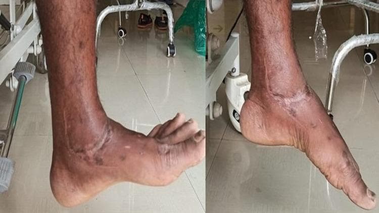 This clinical photograph consists of two side-by-side views of a left ankle and foot, documenting the postoperative range of motion six months following the surgical repair of a complex talar body fracture-dislocation. The images demonstrate the ankle in two distinct positions: a neutral position (left) and active plantarflexion (right). Visible on the anterior and medial aspects of the ankle are well-healed surgical scars, consistent with a direct medial approach used for fracture reduction and internal fixation. There is mild residual soft tissue swelling and hyperpigmentation/discoloration around the ankle joint and dorsum of the foot, indicative of tissue remodeling post-trauma. The photograph serves as clinical evidence of successful functional recovery, showcasing the patient's ability to achieve significant plantarflexion and maintain structural alignment of the foot relative to the lower leg after a severe orthopedic injury. This image is used in medical education to illustrate postoperative outcomes in complex foot and ankle trauma management.