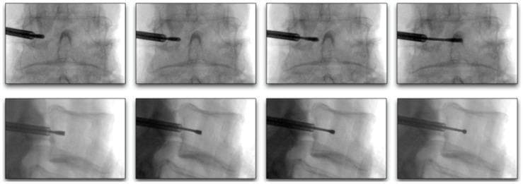 This diagnostic image sequence consists of eight fluoroscopic frames arranged in two rows, illustrating the progression of a curved stylet during a minimally invasive spinal procedure, such as basivertebral nerve ablation or vertebral augmentation. The top row displays an anterior-posterior (AP) view, showing the stylet advancing from a lateral transpedicular entry point toward the 25-40% midline of the vertebral body. Key landmarks visible include the pedicles, vertebral endplates, and spinous process. The bottom row displays a lateral view of the same lumbar vertebral level, demonstrating the stylet's trajectory as it moves from the posterior cortex into the anterior two-thirds of the vertebral body, remaining centered between the superior and inferior endplates. The sequence highlights the spatial relationship between the surgical instrument and the bony anatomy of the spine, emphasizing the precise placement required to reach the target zone while avoiding cortical perforation. This material is designed for intermediate to advanced medical educational indexing in the fields of interventional pain management, radiology, and orthopedic surgery.