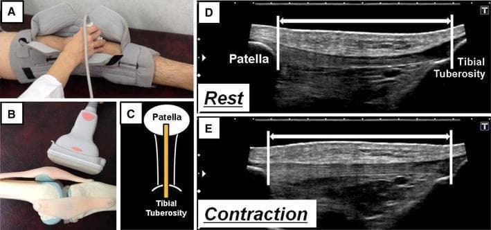 This composite image illustrates a musculoskeletal ultrasound evaluation of patellar mobility. Panels A and B show the clinical setup: a patient in a supine position with the knee secured in a semi-flexed brace while a high-frequency linear ultrasound probe is positioned sagittally over the anterior knee using a water bag interface. Panel C provides a schematic diagram identifying the patella, patellar tendon (yellow), and tibial tuberosity. Panels D and E present sagittal B-mode ultrasound images of the extensor mechanism at rest and during isometric knee extension contraction, respectively. The ultrasound images clearly demonstrate the caudal pole of the patella (superiorly) and the tibial tuberosity (inferiorly), connected by the fibrillar, echogenic patellar tendon. Markers indicate the distance between the deep insertion of the patella and the tibial tuberosity, highlighting a superior shift of the patella (shortened distance) during contraction compared to the resting state. This visual assessment is used to quantify patellar tracking and patellar tendon dynamics in sports medicine and rehabilitation contexts.