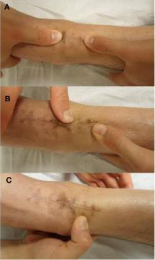 A clinical photograph series consisting of three panels (A, B, and C) demonstrating manual physical therapy techniques applied to the human forearm. The focus is on a chronic surgical scar or linear skin lesion characterized by hyperpigmented, punctate markings and slightly indurated edges. Panel A illustrates the 'push-pull' technique, where digits apply opposing traction to mobilize underlying connective tissue. Panel B shows the 'Indian burn' (torsional) maneuver, applying rotational force across the scar line to improve tissue elasticity. Panel C demonstrates a 'J stroke' technique, involving a localized, curved compression motion near the wrist. These images serve as educational material for Soft Tissue Mobilization (STM), highlighting manual intervention strategies to treat fascial restrictions and improve skin-to-subcutaneous mobility in postoperative or rehabilitative contexts. The skin surface appears treated with a topical emollient to facilitate gliding during manipulation.
