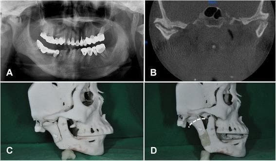 This composite of four images (A-D) illustrates the diagnostic and pre-surgical planning for right-sided temporomandibular joint (TMJ) ankylosis and resulting facial asymmetry.
Image A is a panoramic radiograph showing significant flattening and fusion of the right TMJ (ankylosis) and a shortened right mandibular ramus, leading to a mandibular midline shift and facial asymmetry.
Image B is a coronal CT scan providing detailed visualization of the right TMJ, highlighting fibrous or bony adhesion between the condyle and the glenoid fossa.
Image C and D show a 3D-printed rapid prototype model of the patient's skull used for surgical simulation. In Image C, the baseline anatomical deformity is visible. In Image D, a planned reverse L-shaped osteotomy line is indicated by a white dotted line on the mandibular ramus. This model demonstrates the application of a distraction device (distractor) intended for distraction osteogenesis, aimed at increasing ramal height and releasing the ankylotic segment to restore jaw function and facial symmetry.