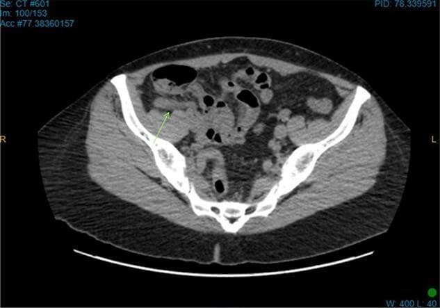 This diagnostic image is an axial computed tomography (CT) scan of the lower abdomen and pelvis, demonstrating diagnostic findings of acute appendicitis. The view captures the cross-sectional anatomy of the iliac bones (bright white, high-density structures) and pelvic musculature. A green arrow points specifically to a thickened, tubular structure in the right iliac fossa, located in a retrocecal position, which is consistent with an inflamed appendix. Pathological features include increased density and a hazy, smudged appearance of the adjacent mesenteric fat, known as fat stranding, which indicates local inflammatory infiltration. Several air-filled bowel loops are visible within the abdominal cavity. This imaging is characteristic of an emergency surgical presentation, used to differentiate between causes of right lower quadrant pain, such as acute appendicitis or appendiceal diverticulitis.