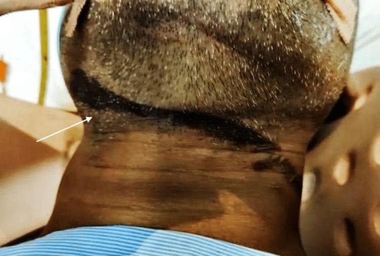This clinical photograph shows a close-up, inferior-to-superior view of the neck and submental region of an intubated patient. A prominent, dark-pigmented ligature mark is visible, indicated by a white arrow. The mark is a circumferential, superficial abraded furrow that follows an oblique path across the neck. It is situated at the level of the cricoid cartilage, extending from the right mandibular angle and slanting across the anterior cervical region. The skin within the furrow appears dark, dried, and parchment-like, which is characteristic of ligature marks in cases of hanging. The patient is shown with medical adjuncts, including adhesive tape on the chin and a striped garment at the bottom of the frame, indicating a hospital or forensic clinical setting. This image serves as an educational example in forensic medicine and emergency trauma for identifying and documenting ligature injuries associated with near-hanging or strangulation events.