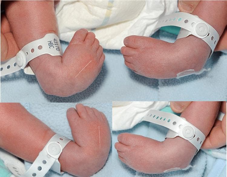 This composite clinical photograph displays a newborn's feet from multiple angles, demonstrating bilateral congenital talipes equinovarus (CTEV), commonly known as clubfoot. The visual features exhibit the characteristic four components of the deformity: hindfoot equinus (downward pointing of the foot at the ankle), hindfoot varus (inward tilting of the heel), midfoot adductus (medial deviation of the forefoot), and cavus (high medial longitudinal arch). Notable clinical signs include deep skin creases on the medial aspect of the midfoot and posterior aspect of the ankle. The infant is wearing white hospital identification bands around both lower legs. This image serves as an educational tool in pediatric orthopedics to illustrate the physical presentation of idiopathic clubfoot at birth, which is typically assessed using the Pirani or Dimeglio scoring systems for severity before initiating Ponseti method manipulative treatment.