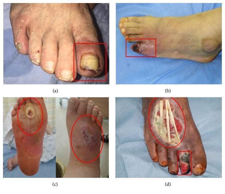 A series of four clinical photographs (a-d) demonstrating the progression of diabetic foot ulcers categorized by the Wagner classification system. (a) Wagner Grade 1: A superficial ulcer on the left hallux (big toe) featuring erythema, periungual inflammation, and a thickened, discolored yellowish toenail, indicative of an ischemic etiology. (b) Wagner Grade 2: A deep ulcer on the fifth digit (pinky toe) showing more extensive tissue involvement and localized cyanosis. (c) Wagner Grade 3: A neuropathic perforating ulcer extending from the plantar surface to the dorsum of the foot, associated with deep infection, abscess, and clinical signs of osteomyelitis. (d) Wagner Grade 4: Advanced diabetic foot pathology exhibiting local gangrene of the second toe and a large, deep dorsal foot ulcer. The necrotic tissue is blackened, and the wound bed is exposed, revealing underlying anatomical structures such as tendons. This set illustrates the clinical manifestations of ischemic, neuropathic, and mixed-type diabetic foot disease for educational use in wound care and endocrinology.