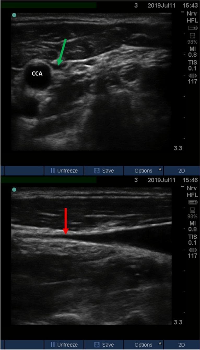 Two-panel B-mode diagnostic ultrasound image demonstrating the assessment of Ultrasound-measured Jugular Venous Pressure (U-JVP) in a semi-recumbent patient. The top panel shows a transverse (short-axis) view of the neck vasculature. The common carotid artery (CCA) appears as a prominent, non-compressible, round anechoic structure. Adjacent to it, a green arrow indicates the collapsed internal jugular vein (IJV), which lacks a patent lumen. The bottom panel displays a longitudinal (long-axis) view of the same region. The internal jugular vein is seen tapering as it moves superiorly, with the red arrow marking the specific 'collapse point' where the anterior and posterior walls of the vein meet. This technique is used in clinical cardiology and emergency medicine as a non-invasive bedside proxy for central venous pressure (CVP) and fluid status assessment, particularly when physical examination of jugular venous distension is difficult.
