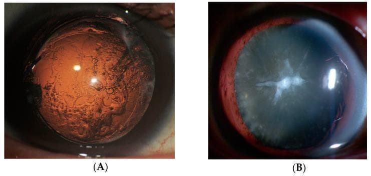 Two slit-lamp clinical photographs showing different forms of lens opacification and fibrosis. Figure A is a retroillumination image demonstrating Posterior Capsular Opacification (PCO), a common post-cataract surgery complication. The lens capsule displays diffuse brownish discoloration and a characteristic textured appearance consisting of irregular dark patches, branching patterns, and small circular clusters (Elschnig pearls) indicative of aberrant lens epithelial cell (LEC) migration and proliferation. Figure B illustrates an anterior subcapsular cataract with anterior subcapsular fibrosis (ASF). The image reveals a prominent, bright white, star-like (stellate) central opacity at the anterior pole of the lens, surrounded by a more diffuse, grayish-white opacity. This fibrotic plaque is the result of epithelial-mesenchymal transition (EMT) of LECs into myofibroblastic cells. Both images highlight pathological consequences of LEC dysfunction and fibrosis in ophthalmology.