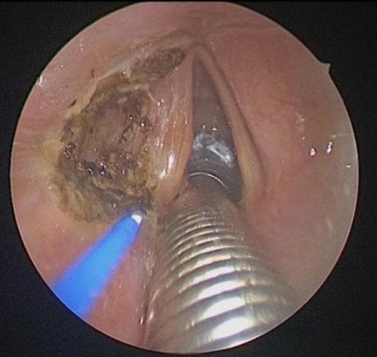 This endoscopic clinical photograph captures an intraoperative view of the larynx during a posterior ventriculo-cordectomy. The image demonstrates a transverse incision of the left ventricular fold (false vocal cord), which has been performed using a contact diode laser. The surgical site on the left lateral aspect shows significant tissue alteration, characterized by a dark, irregular, and charred surface consistent with laser thermal coagulation and vaporization. This procedure aims to remove a sail-shaped portion of the fold to reveal the superior aspect of the true vocal fold and open Morgagni's ventricle. Centrally positioned in the foreground is a metallic, corrugated endotracheal tube, likely a laser-protected tube required for airway management under general anesthesia. To the left, a laser fiber tip is visible, emitting a characteristic blue light, indicating active thermal application. The surrounding laryngeal mucosa appears hyperemic, a typical response to surgical trauma. This visual is used to teach endoscopic laryngeal surgery techniques and the management of narrowed airways via laser resection.