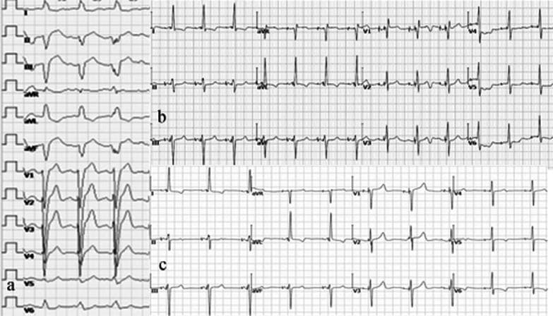 This diagnostic image contains three comparison panels (a, b, and c) of 12-lead electrocardiograms (ECG) demonstrating the evolution of ventricular conduction in a patient with ischemic cardiomyopathy. Panel (a) shows the baseline ECG with a classic Left Bundle Branch Block (LBBB) morphology, characterized by a wide QRS duration (160 ms), broad notched R waves in lateral leads (I, aVL, V6), and deep S waves in precordial leads V1-V3. Panel (b) illustrates unipolar Left Bundle Branch Area Pacing (LBBAP), showing a transition to a Right Bundle Branch Block (RBBB) pattern with a reduced QRS duration of 122 ms, indicated by terminal R' waves in lead V1. Panel (c) displays pacing with Left Bundle Branch Optimized Cardiac Resynchronization Therapy (LOT-aCRTD). This configuration demonstrates 'LBBB correction,' resulting in the narrowest QRS duration (120 ms) and a more physiological depolarization pattern. The image serves as an educational comparison of cardiac pacing modalities and their impact on ventricular synchronization and QRS morphology.