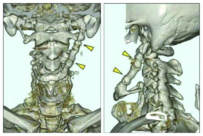 This diagnostic image consists of two panels showing a three-dimensional (3D) CT reconstruction of the human cervical region and skull base in posterior and oblique views. The primary finding is a significantly elongated and thickened left styloid process (indicated by yellow arrowheads) that exhibits complete bony fusion with the hyoid bone. This ossified stylohyoid complex measures approximately 70 mm in length and maintains a uniform thickness of roughly 10 mm. The surrounding anatomical structures, including the cervical vertebrae (C1-C7), mandible, and upper thoracic cage (clavicles and ribs), appear normally aligned. The right styloid process is visible but significantly shorter and disconnected from the hyoid. This presentation is characteristic of a severe anatomical variant of Eagle Syndrome, demonstrating the progressive ossification of the stylohyoid ligament and its impact on the anatomical relationship between the temporal bone and the hyoid apparatus, which can lead to symptoms like dysphagia and orofacial pain.