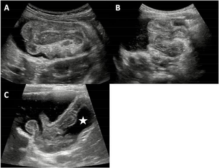 This medical visual consists of three transabdominal ultrasound panels (A, B, and C) demonstrating the progression of ultrasound-guided saline enema reduction for pediatric intussusception. Panel A shows a classic 'pseudokidney' or 'target' sign in longitudinal section, representing the intussusceptum (invaginated bowel) within the intussuscipiens, surrounded by anechoic saline. Panel B captures the dynamic reduction phase where the intussusception is visibly shortened as retrograde hydrostatic pressure from the saline enema pushes the bowel segment back toward its anatomical position. Panel C confirms successful reduction, characterized by the complete disappearance of the layered mass and the visualization of anechoic saline passing through the ileocecal valve into the terminal ileum (indicated by a white star). This sequence illustrates the therapeutic utility of real-time sonography in managing ileocolic intussusception, emphasizing key landmarks such as the concentric rings of the bowel wall and the return of fluid flow to obstructed segments.