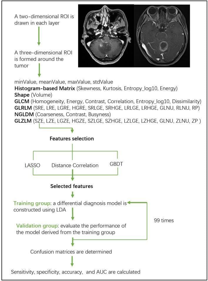 A medical flowchart outlining a radiomics-based MRI classification workflow for differentiating brain tumors, such as glioblastoma and anaplastic astrocytoma. The process begins with axial T1-weighted contrast-enhanced MRI images, followed by 2D and 3D Region of Interest (ROI) segmentation around the tumor. The diagram details the extraction of high-dimensional texture features, including histogram-based metrics (Skewness, Kurtosis), shape parameters (Volume), and various gray-level matrices: GLCM, GLRLM, NGLDM, and GLZLM. The pipeline proceeds to feature selection using LASSO, Distance Correlation, or GBDT methods. A differential diagnosis model is then constructed using Linear Discriminant Analysis (LDA) on a training dataset and evaluated with a validation group. This machine-learning cycle is iteratively performed 99 times to ensure robustness. The final stage involves diagnostic performance evaluation through confusion matrices and the calculation of sensitivity, specificity, accuracy, and Area Under the ROC Curve (AUC). This visual resource illustrates the application of texture analysis and artificial intelligence in neuroradiology and oncology.