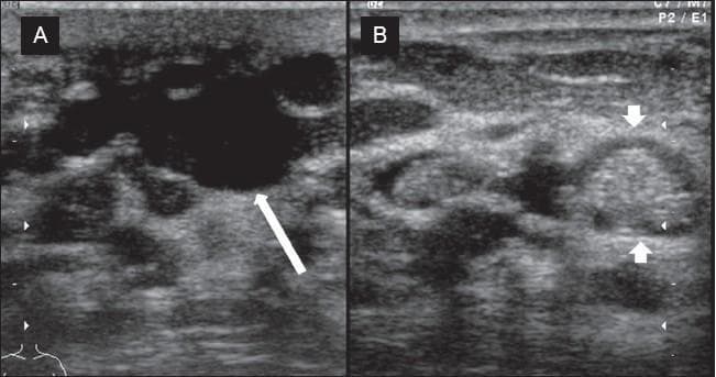 This diagnostic ultrasound image demonstrates chronic duct ectasia in the breast parenchyma, presented in two planes. Image A (longitudinal view) shows a significantly dilated, tubular, and elongated duct. The lumen is predominantly filled with anechoic fluid, but also contains focal areas of increased echogenicity (white arrow) representing inspissated debris. Image B (cross-sectional view) displays the same pathology where the intraductal debris appears as a rounded, focal lesion with heterogeneous echogenicity (white arrowheads). The lesion is contained within the margins of the ductal structure and is surrounded by typical breast parenchymal echotexture. These visual features are characteristic of mammary duct ectasia, where accumulated secretions and cellular debris can sometimes mimic solid masses. The modality is high-resolution gray-scale ultrasonography, used here to distinguish between simple cysts, solid masses, and benign ductal dilation with internal echoes.