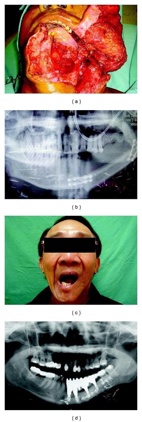 A multi-panel series of clinical and diagnostic images illustrating oromandibular reconstruction following lower gum cancer ablation. (a) Intraoperative clinical photograph showing a massive anterolateral oromandibular defect after tumor resection, exposing oral cavity structures. (b) Panoramic radiograph (orthopantomogram) demonstrating immediate post-operative results of a fibular osteocutaneous free flap reconstruction. The fibular bone segment is integrated into the mandibular arc and secured using radiopaque surgical miniplates and screws for bony fixation. (c) Post-operative clinical photograph of the patient showing successful aesthetic restoration and functional recovery, evidenced by an adequate range of mouth opening. (d) Follow-up panoramic radiograph showing long-term structural outcomes, including the successful osseointegration of multiple dental implants within the reconstructed fibula flap bone. The image highlights the suitability of fibular bone architecture for supporting dental prosthetics and maintaining mandibular continuity. This series serves as an educational resource for plastic and reconstructive surgery, specifically focusing on microvascular free flap techniques and oral rehabilitation.