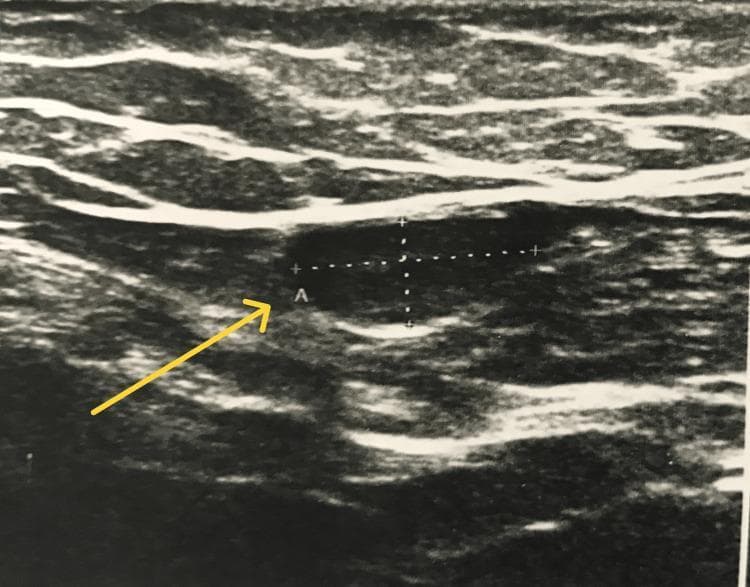 This diagnostic ultrasound image demonstrates an undescended testis (cryptorchidism) located within the inguinal canal. The testis is identified by a yellow arrow pointing to a well-defined, oval, hypoechoic structure relative to the surrounding soft tissue layers. Measurement calipers are positioned over the testicular parenchyma to assess its dimensions. The surrounding anatomical environment shows stratified layers of variable echogenicity, representing subcutaneous fat, fascia, and inguinal musculature. The testicular tissue itself appears relatively homogeneous in texture, a common sonographic finding for an ectopic or undescended testis. This imaging is characteristic of pediatric or adolescent urological evaluations where a testis is non-palpable in the scrotum. The educational focus of this image is the sonographic identification of undescended testes and the differentiation of testicular parenchyma from adjacent inguinal lymph nodes or surrounding soft tissues.