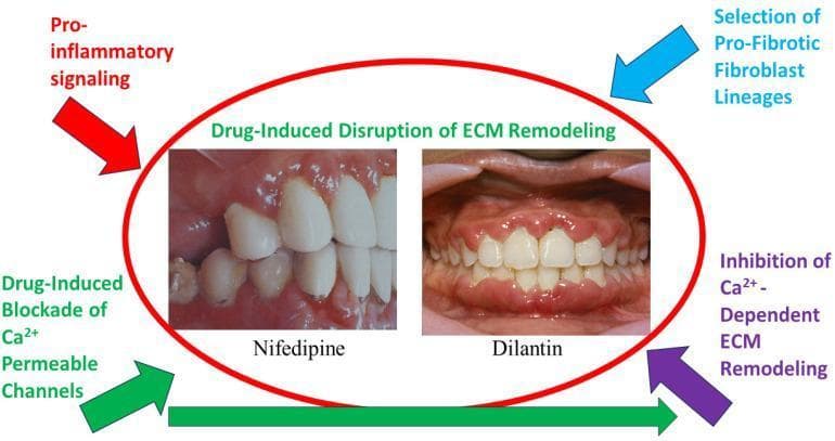 This medical visual combines clinical intraoral photographs with a conceptual diagram to illustrate drug-induced gingival overgrowth (DIGO). The central photographs compare the gingival manifestations of two specific pharmacological agents: Nifedipine (a calcium channel blocker) and Dilantin (Phenytoin, an anticonvulsant). The Nifedipine clinical image displays erythematous, swollen gingival margins with moderate hyperplasia. The Dilantin image demonstrates more severe, generalized gingival overgrowth characterized by bulbous interdental papillae and extensive coverage of the clinical crowns by thickened, lobulated gingival tissue. Surrounding these images is a pathophysiological flow diagram explaining the mechanism of extracellular matrix (ECM) disruption. Key educational concepts mapped include the drug-induced blockade of calcium-permeable channels (such as TRPV4), the inhibition of calcium-dependent ECM remodeling, and the selection of pro-fibrotic fibroblast lineages. The diagram highlights how pro-inflammatory signaling synergizes with these drug effects to disturb the homeostatic balance of collagen synthesis and degradation in periodontal tissues, leading to the observed pathological tissue enlargement.