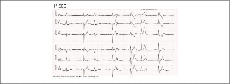 This diagnostic image is a 12-lead electrocardiogram (ECG) demonstrating a rare alternating bundle branch block pattern associated with second-degree atrioventricular (AV) block. The tracing reveals a beat-to-beat alternation in QRS morphology: one beat exhibits a Right Bundle Branch Block (RBBB) pattern (characterized by an rsR' 'rabbit ear' morphology in lead V1), while the subsequent beat displays a Left Bundle Branch Block (LBBB) pattern (notched or slurred R waves in lateral leads like V5-V6). Additionally, the ECG shows features of Mobitz Type I (Wenckebach) AV block, evidenced by progressive prolongation of the PR interval until a P wave fails to conduct to the ventricles, resulting in a dropped QRS complex. This combination suggests significant, multi-level disease of the infra-nodal conduction system (His-Purkinje system). The educational focus of this visual is the recognition of unstable intraventricular conduction delays and high-grade AV block patterns that often necessitate pacemaker intervention.