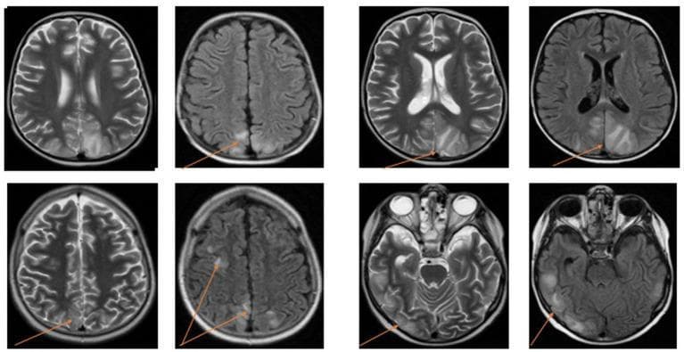 Diagnostic Imaging: This composite shows multiple axial brain MRI slices from two patients, utilizing T2-weighted and Fluid-Attenuated Inversion Recovery (FLAIR) sequences. The images demonstrate the classic presentation of Posterior Reversible Encephalopathy Syndrome (PRES). Key findings include bilateral, often symmetrical, areas of hyperintense signal within the subcortical white matter and overlying cortex. These abnormalities are most prominent in the posterior regions, specifically the occipital and parietal lobes, though frontal lobe and temporal lobe involvement is also visible. Orange arrows highlight focal areas of vasogenic edema, which appear as bright signal intensities on both T2 and FLAIR images. The FLAIR sequences clearly distinguish these pathological signal changes from the dark, suppressed cerebrospinal fluid (CSF) in the ventricles and sulci. The distribution pattern is highly characteristic of the vasogenic edema seen in PRES, often associated with acute hypertension or preeclampsia/eclampsia. This imaging series serves as an educational example of neuroradiological manifestations of cerebral autoregulation failure.