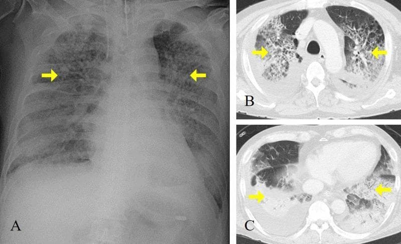 This composite diagnostic image features a chest X-ray (A) and axial CT scans (B, C) of a patient with Acute Respiratory Distress Syndrome (ARDS). (A) An anteroposterior chest radiograph demonstrates diffuse, bilateral alveolar infiltrates and patchy opacification across both lung fields, notably sparing the upper zones, with a normal cardiac silhouette and no signs of cardiomegaly. Yellow arrows highlight dense consolidation in the mid-lung regions. (B, C) Axial CT images at different thoracic levels reveal extensive, bilateral ground-glass opacities and dense consolidation, particularly in the dependent posterior regions of the lower lobes. Associated reticular patterns suggest interstitial involvement. The mediastinal structures and great vessels appear normal, and there is no evidence of significant pleural effusion. The imaging findings are classically consistent with non-cardiogenic pulmonary edema and diffuse alveolar damage typical of severe viral pneumonia (e.g., H1N1 influenza) progressing to ARDS. This material is suitable for training in intensive care medicine and radiology, focusing on the visual differentiation between cardiogenic and non-cardiogenic pulmonary opacities.