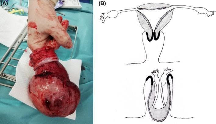 The image consists of two parts: (A) a clinical photograph of a surgically resected uterus and (B) an anatomical diagram illustrating uterine inversion. Panel A shows a gross pathological specimen of a total hysterectomy. The uterus appears as an enlarged, reddish, irregular mass with a bulbous uterine body and a distinct whitish, constricted cervical region. A surgical operator's finger is inserted into a central depression, representing the fundic invagination, which demonstrates the inverted state where the endometrial surface is on the exterior. Panel B provides a schematic comparison between normal uterine anatomy (top) and total uterine inversion (bottom). The diagram highlights the descent of the uterine fundus through the cervical canal and the subsequent 'cupping' or invagination of the adnexal structures (fallopian tubes and ovaries) into the resulting void. This visual provides clinical context for non-puerperal uterine inversion, often associated with heavy intrauterine masses like adenomyosis or myomas, emphasizing the structural transformation that occurs during this rare gynecological emergency.