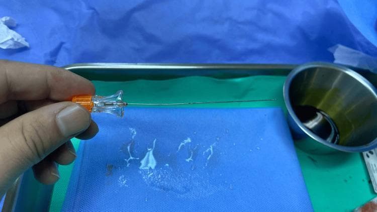 This clinical photograph displays a 22-gauge Quincke spinal needle held horizontally above a sterile surgical field. The needle features a transparent, ergonomic plastic hub with an orange-coded stylet base, consistent with standard color-coding for 22G needles. The shaft is composed of stainless steel, culminating in a sharp, beveled 'cutting' tip designed for dural penetration during neuraxial anesthesia. The background comprises an intraoperative setting, including a blue surgical drape with visible fluid droplets, a green plastic utility tray, and a stainless steel prep bowl containing an antiseptic solution, likely povidone-iodine. This image serves as an educational reference for regional anesthesia equipment, illustrating the structural components of a standard Quincke-type needle used in lumbar punctures or spinal anesthesia procedures to facilitate cerebrospinal fluid (CSF) access.