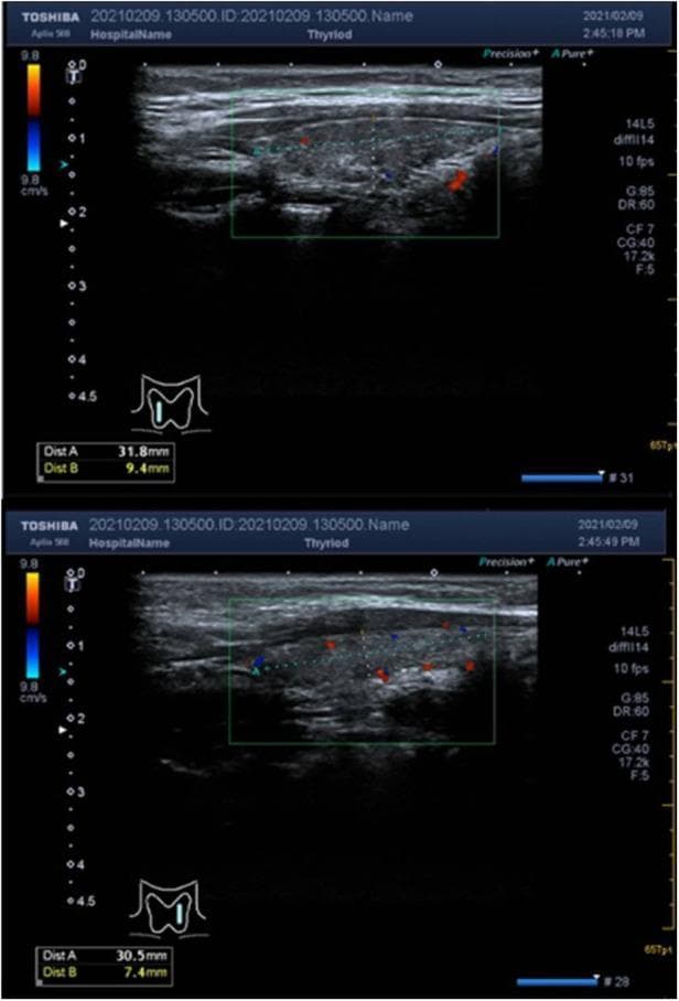 This diagnostic image consists of two sagittal-view ultrasound frames of the thyroid gland utilizing color Doppler. The imaging depicts the right and left lobes of the thyroid, showing a characteristic hypoechoic and heterogeneous parenchymal echogenicity. The texture of the gland appears non-uniform and darker relative to adjacent musculature, which is a common sonographic finding in autoimmune thyroiditis (Hashimoto's thyroiditis). Annotations and dashed measurement lines indicate the dimensions of the lobes, with the superior-inferior diameters measuring approximately 31.8 mm and 30.5 mm respectively. The color Doppler overlays (red and blue signals within the green sampling box) demonstrate normal vascularity without evidence of pathological hypervascularity (the 'thyroid inferno' pattern). There are no discrete solid or cystic nodules, masses, or occupancy areas visible in either lobe. This visual presentation is educationally significant for identifying parenchymal changes in chronic thyroid inflammation and differentiating normal blood flow from the hypervascularity seen in Graves' disease.